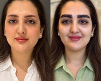 چطور بهترین کلینیک کاشت ابرو در مشهد را انتخاب کنیم؟ یک راهنمای جامع و کاربردی تصویر نمونه قبل و بعد کاشت ابرو