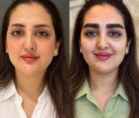 چطور بهترین کلینیک کاشت ابرو در مشهد را انتخاب کنیم؟ یک راهنمای جامع و کاربردی تصویر نمونه قبل و بعد کاشت ابرو